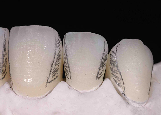 Prothèses dentaires