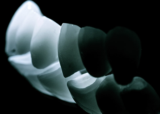 Prothèses dentaires