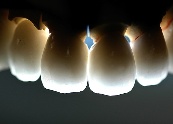 Prothèses dentaires