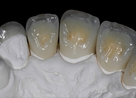 Prothèses dentaires