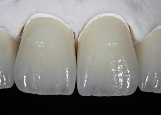 Prothèses dentaires