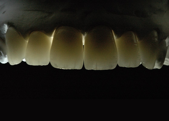 Prothèses dentaires